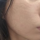 네스트의원 | [서울/신논현]쥬베룩스킨&amp;PDRN 후기 | 네스트의원 강남