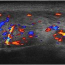 Salivary gland inflammation 이미지