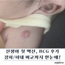 신생아 예방접종 BCG 주사 후기 - 경피용/피내용 BCG 비교, 검단신도시 경피용 BCG 병원 정보