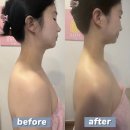북수로 | 아산피부샵 바른미피부관리실에서 라운드숄더 거북목 관리받은 후기