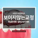 수치과기공소 | 수정구 수진동 치과 보이지 않는 교정, 설측교정의 매력