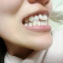선이아름다운치과의원 | 주걱턱 교정기 내돈내산 4개 월차 후기