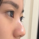 안계약국 | 내돈내산 코수술 후기 (발품부터 수술5일차까지)+코수술준비물