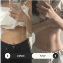 강남 복부 지방분해주사 후기 : 아랫배 군살 라인 하프하게 만들어주는 비만클리닉 1주차 기록