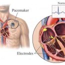 인공 심장박동기란? 이미지