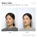 르수플