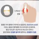 엄지손가락 통풍 초기증상 발생 원인 &amp; 대처법 이미지