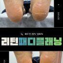 리턴스킨 | 발각질 제거 전후 확실한 변화 | 산본 리턴스킨 패디플래닝 후기