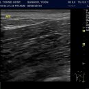 Appendictis ?? Diverticulitis? 이미지