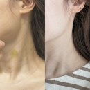 디어멍 | 압구정 선천적 가로 목주름 시술 디어넥주사 효과 후기