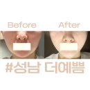 위즈네일&스킨 | 성남 에스테틱 추천 :: 성남 신흥역 ' 더예쁨 ' 에서 윤곽관리 받음