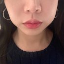 사랑니아프니 강남본점 추천 사랑니 3개 발치 일주일 경과 후기(+드라이소켓)