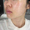 시흥 배곧피부과 추천 엘뷰티의원 30대 여자 리제반, 눈가주름 스킨보톡스 내돈내산 후기