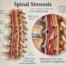허리와 다리 저림 통증 척추협착증 증상부터 원인, 관리 방법 ~~ 이미지
