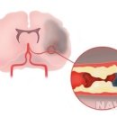 허혈성 뇌졸중 이미지