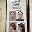 대구 피부과 추천｜덴서티 고민하다가 올타이트리프팅 받고 온 후기