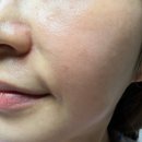 리바이브 | 파주피부과 리바이브 스킨부스터 스킨보톡스 효과 솔직 후기