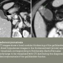 focal adenomyomatosis 이미지