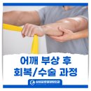 삼성바이오에피스부속의원 | 대구 율하정형외과 어깨 부상 후 회복 수술까지의 과정