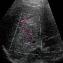 Focal nodular hyperplasia in the liver 이미지