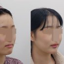 양악 + 윤곽 3종 ( 광대뼈, 사각턱, 턱끝 ) / 2Jaw+ Facial Contouring Surgery (양윤돌 / 2YD)
