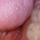 김치과의원 | 오리역 치과 리볼리치과의원 사랑니 발치 후기 “미루다 미루던 사랑니… 생각보다 훨씬 수월하게 뽑고...