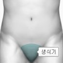 소아청소년질환 고환 여성화 증후군 (Testicular feminization syndrome)이란? 이미지