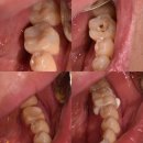 덴인(Denin) | 세라믹 인레이 치료, 레진치료 후에도 통증이 있으면 MTA 이런걸로 헤메지 말고 한방에 신경치료 크라운...