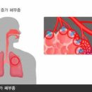 폐에 물이 차면 &amp; 폐에 물이 차는 이유 (폐부종 , ). 이미지