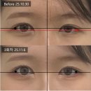 해뜨는한의원 | 눈 뜨는 힘이 달라요? 눈 비대칭 치료 하셔야 합니다...포함)_강남구청역 눈 비대칭 한의원_자연산 한의원