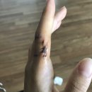 다경호프 | 3- 손가락 내연골종 양성종양 수술 후기 :(
