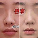 서울美성형외과 | 복코성형 어려운 이유? 코끝 연골, 피부 두께에 따른 방법!
