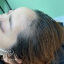 동명헤어라인 | 사하구헤어라인문신으로 자연스러운 이미지 변신하기