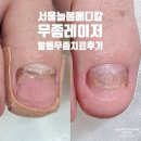 이안메디칼 | [발톱무좀 한달반] 서울늘봄메디칼내과의원 발톱색깔이 이상해요