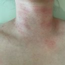 이유한의원 | [강남 한의원 후기] 목 주변 편평사마귀 제거, 아인침으로 말끔하게 치료