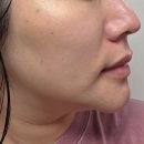 (주)셀포인트 | 판교역 피부과 줄기세포주사 자가엑소좀 메타셀 통증 효과 후기 전후