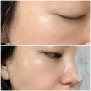 (주)닥터장솔루션 | 기미 잡티 제거 마스크팩 닥터오기덤 앰플샷 화이트닝 일주일 사용 후기