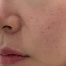 에테르코 | 압구정피부과 팔자주름 실리프팅 후기 압구정 에테르나 팔자 실리프팅 두줄 후기