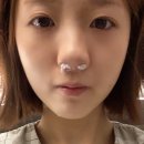 [수술 후기] 비중격만곡증 수술, 하비갑개절제술. 숨통 트인 리얼 후기 :)