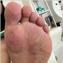 (주)바이진 | 광주 운남동 발각질 제거 깔끔하게 잘하는 네일바이진 내성발톱 무좀발톱 발각질 문제성발 네일