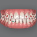 OK치과의원 | 인비절라인으로 앞니 사이 공간과 돌출입 교정 후기, 해외 출장이 잦아도 OK
