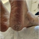 용인 처인구 발각질 뒷꿈치 고민 해결은 뷰티업라이프 김영주네일