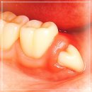UR(파주시)-[책향기로]-하-20 | 운정 매복 사랑니 발치, 마취만 제대로 해도 통증은 거의 없습니다.