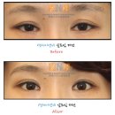 연세이앤비성형외과 | 무분별한 앞트임. 오히려 독? 앞트임재건으로 해결