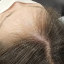 대구제이케이(JK)병원 | 대구두피문신[대구JK두피관리센터]흉터커버후기