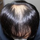 2021-05-0010 | 정수리 모발이식 후기와 이 1가지를 반드시 체크해야만 성공합니다.(사진첨부)