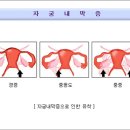 Re:자궁내막증에 대해서 아시는분이여... 이미지