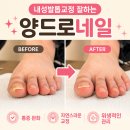 고대해 | 서면내성발톱 교정 잘 해주는 양드로네일