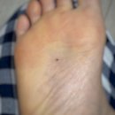 성모외과의원 | 서울 발바닥 점 제거 수술 &amp; 피부암 조직 검사 후기1 | 건대성모외과의원