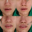 증산피부관리 :: 리아왁싱 에서 재생관리받고왔어요